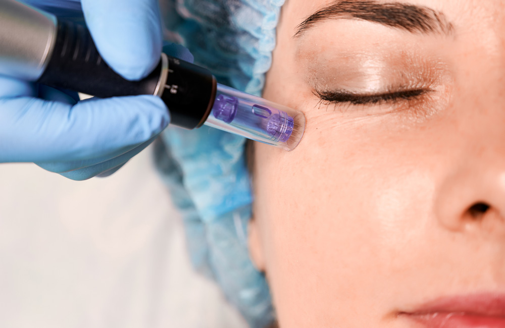 Tratamiento Dermaplaning